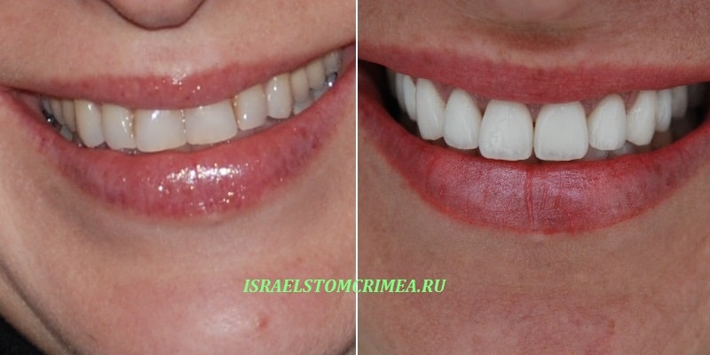 зубы с пломбами до и зубы после восстановления винирами