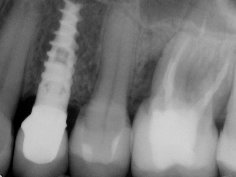 рентген снимок зубного импланта