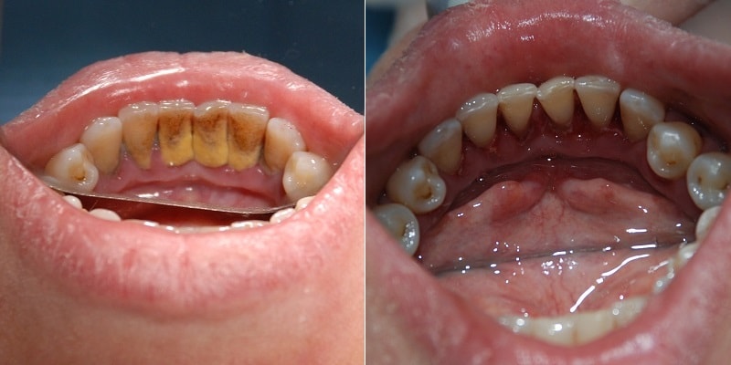 до и после чистки зубов от зубного камня