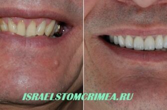 Вид кривых зубов до и после исправления коронками