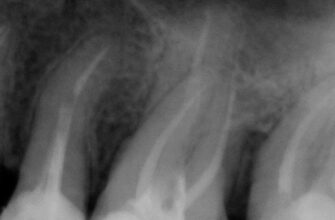 Вид качественно запломбированных каналов зуба на рентгеновском снимке