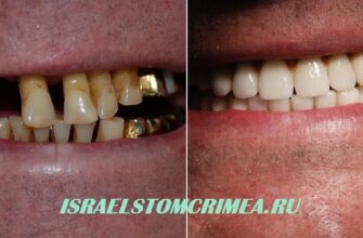 Слева подвижные зубы-справа результат протезирования после немедленной имплантации зубов