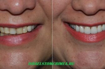 Циркониевые коронки на зубах и имплантах зубы и импланты до и после установки циркониевых коронок