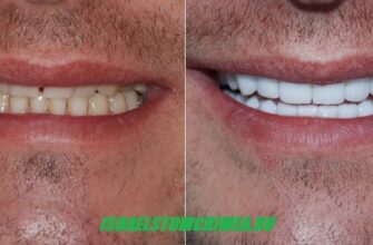 До и после восстановления зубов циркониевыми коронками